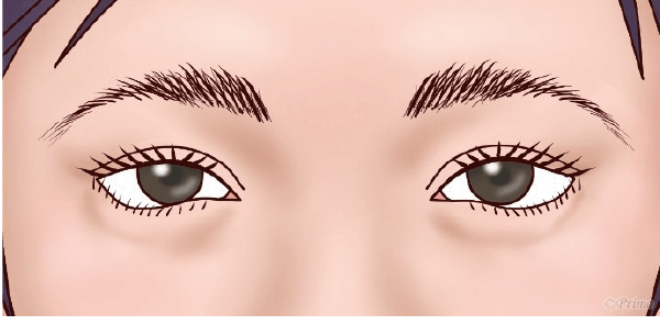 下眼瞼拡大修正術 後の目元イラスト